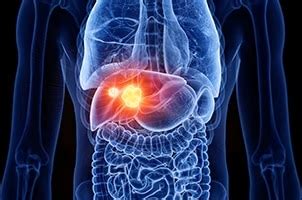 Understanding Liver Cancer: Causes, diagnostics, and therapeutic ...