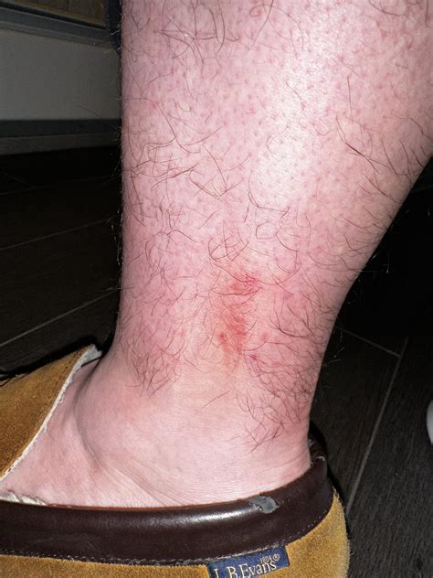 Itchy ankle rash. PCP says it’s nothing but it’s getting worse. : r ...