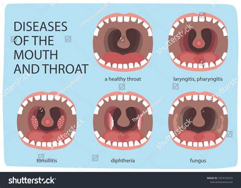 Poster Infographics Illustration Healthy Throat Difference: vector de ...