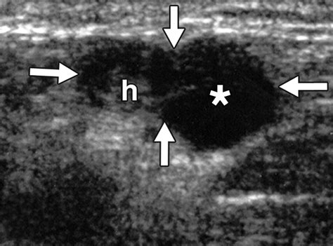 Contrast-Enhanced Ultrasound for Characterizing Lymph Nodes With Focal Cortical Thickening in ...