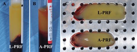 Original Intra-Spin L-PRF (A) and A-PRF (B) clots in their respective ...