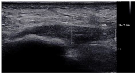 Ultrasound Guided Corticosteroid Injection For Plantar Fasciitis ...