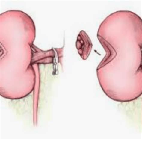 Image result for Nephrectomy Procedure