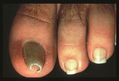 pincer nail correction