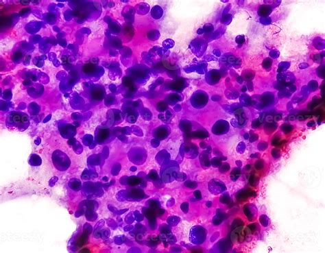 Spindle Cell Sarcoma Treatment at Victoria Jenkins blog