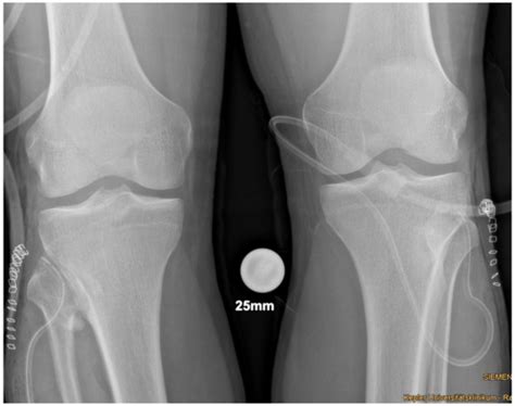 Bilateral Proximal Tibiofibular Synostosis Caused by Osteochondroma in ...