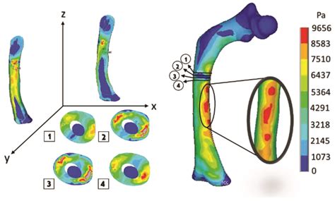 Bone Fractures Numerical Analysis in a Femur Affected by Osteogenesis ...
