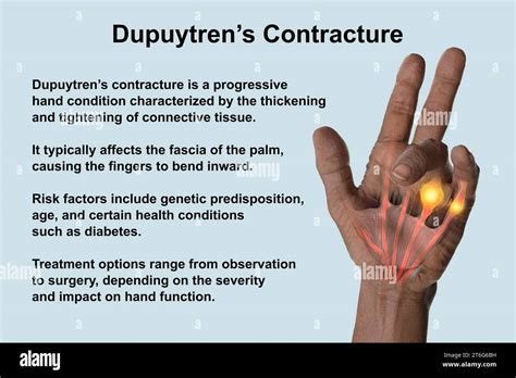 A 3D medical illustration displaying a patient's hand with Dupuytren's ...
