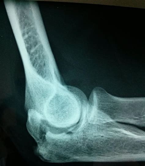 Elbow Fractures