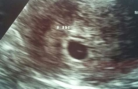 5 week ultrasound and high hcg | BabyCenter