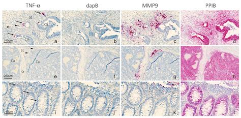 Co-Detection of miR-21 and TNF-α mRNA in Budding Cancer Cells in ...