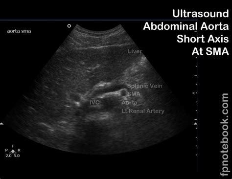 Labeled Abdominal Ultrasound Images at Brandon Myers blog