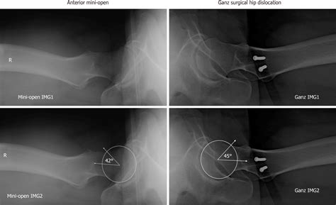 Cam Morphology Femoral Head | Femoral Acetabular Impingement Syndrome – JRQVRN