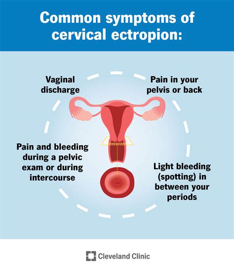 Location Cervix Before Period Cervical Ectropion: Causes, Symptoms