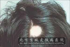 【医生揭秘】女人脱发的主要原因 – 生发垂直网