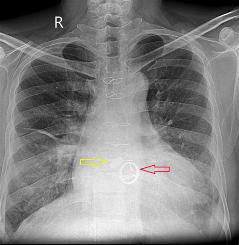 Migration of prosthetic aortic valve into abdominal aorta | Eurorad