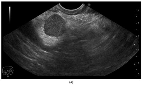 Diagnostics | Free Full-Text | Metastatic Renal Cell Carcinoma to Pancreas: Case Series and ...