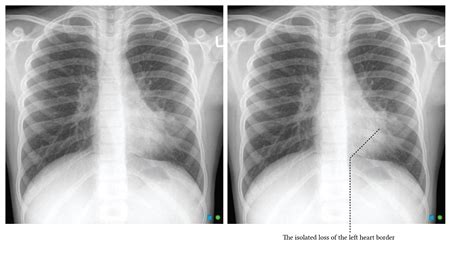 Chest Xray interpretation in ICU | Deranged Physiology