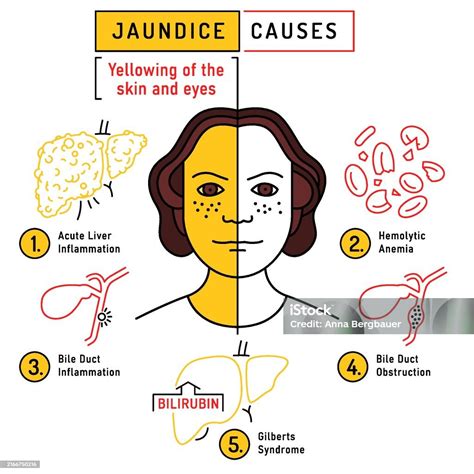 Understanding The Primary Causes Of Jaundice In Adults And Infants