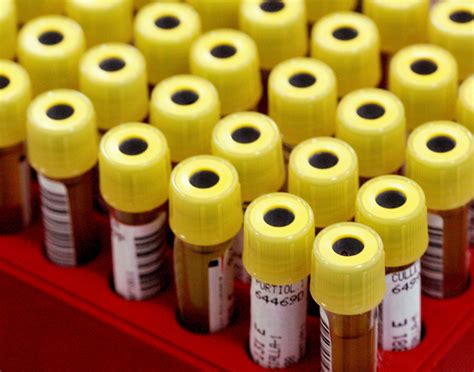 Aspartate aminotransferase (AST) blood test