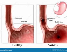 Image result for esophageal ulcer