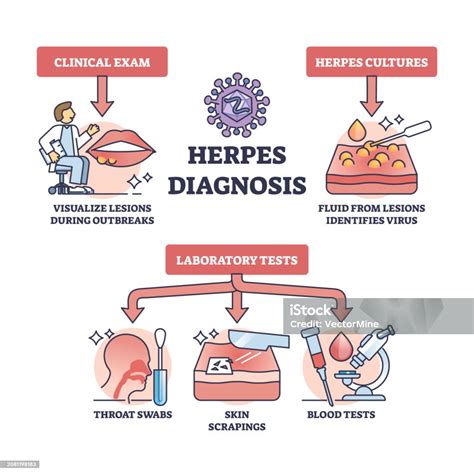 Herpes Diagnosis And Hsv Virus Medical Diagnosis Methods Outline Diagram Stock Illustration ...