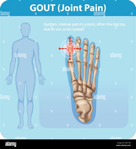 Illustration of gout affecting the big toe joint Stock Vector Image & Art - Alamy