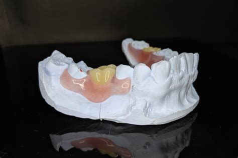 Image result for Front Teeth Partials Options