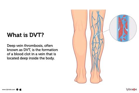DVT Pain 的图像结果