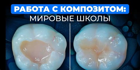Надежный адгезивный подход для прямой композитной реставрации
