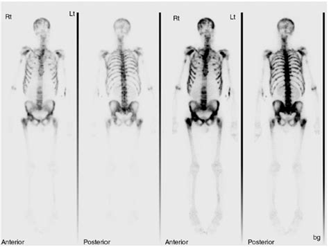 Image result for Radionuclide Scan