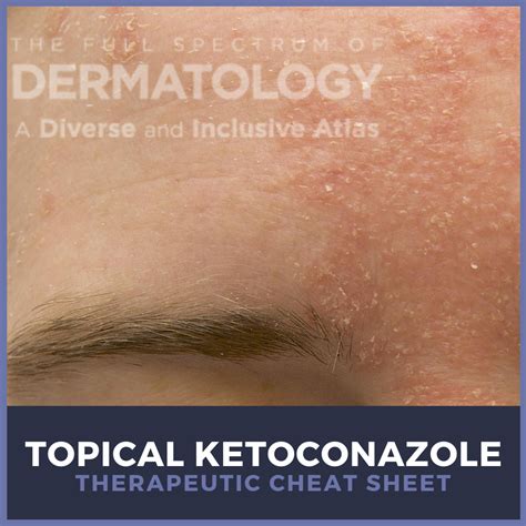 ketoconazole shampoo Archives - Next Steps in Dermatology