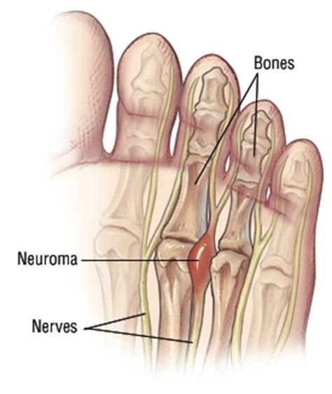 Morton’s Neuroma Intermetatarsal Neuroma | Foot & Ankle Doctors, Inc.