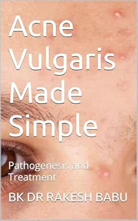 Acne Vulgaris Made Simple: Pathogenesis and Treatment eBook : BABU, BK ...