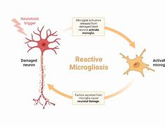 Image result for Microgliosis