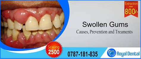 Awesome Info About How To Fix Swollen Gums - Particularspecial