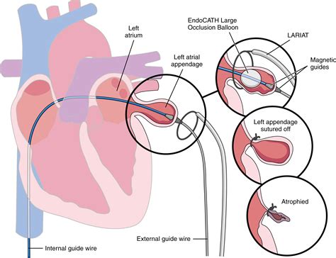 Atrial Fibrillation: Clinical Features, Mechanisms, and Management ...