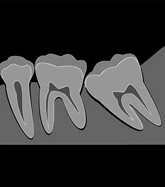 レントゲン 　歯科　フリー に対する画像結果