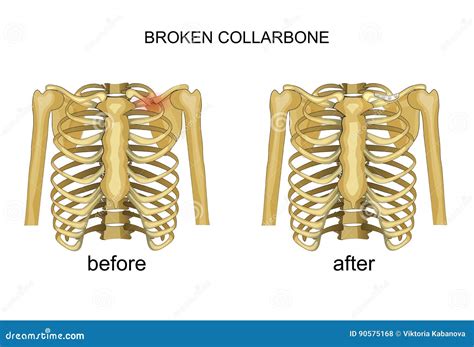 Fracture of the Clavicle. Recovery Stock Vector - Illustration of joint ...