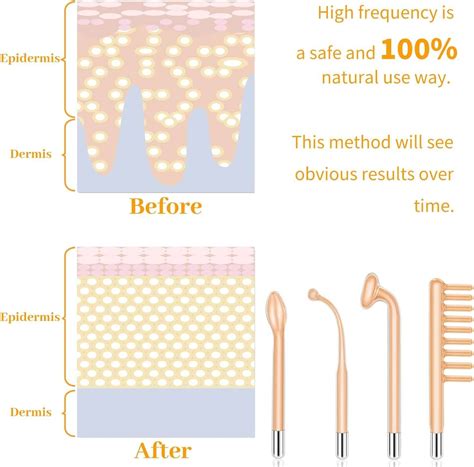 High Frequency Facial Wand: Acne & Anti-Aging Skincare Device