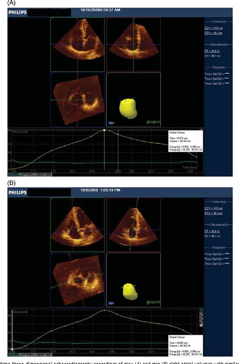 Figure 2 from Normal reference ranges for left and right atrial volume indexes and ejection ...