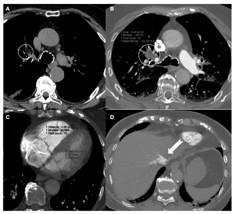 Ct Pulmonary Angiogram
