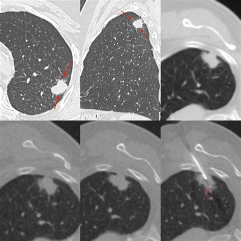 Spiculated Lung Nodule Icd 10 at Brayden Cooke blog