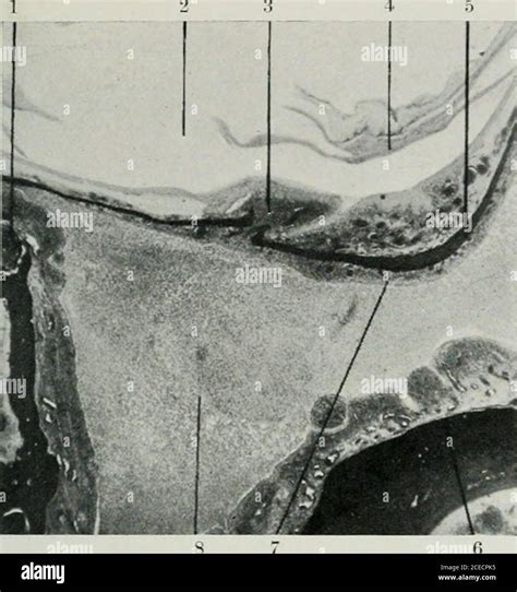 . The Journal of laryngology and otology. the external canal and in the crus commune, but the ...