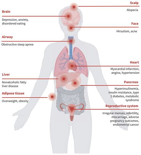 Ultrasound Polycystic Ovary Syndrome