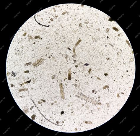 Premium Photo | Microscopic urine examination showing Granular cast, a ...