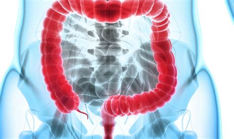Aumento del cáncer colorrectal vinculado a una infección infantil ...
