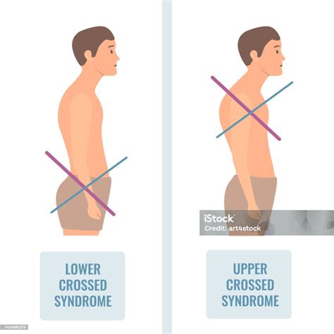 Lower And Upper Crossed Syndrome Body Diagram Stock Illustration ...