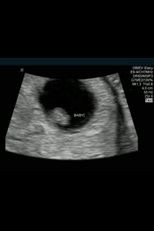 BOY OR GIRL? How to Read Ultrasound Image at 6 Weeks | BabyCenter