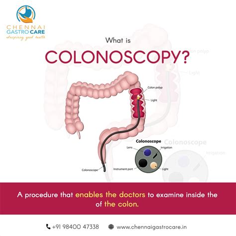 What happens during and after a colonoscopy – Artofit